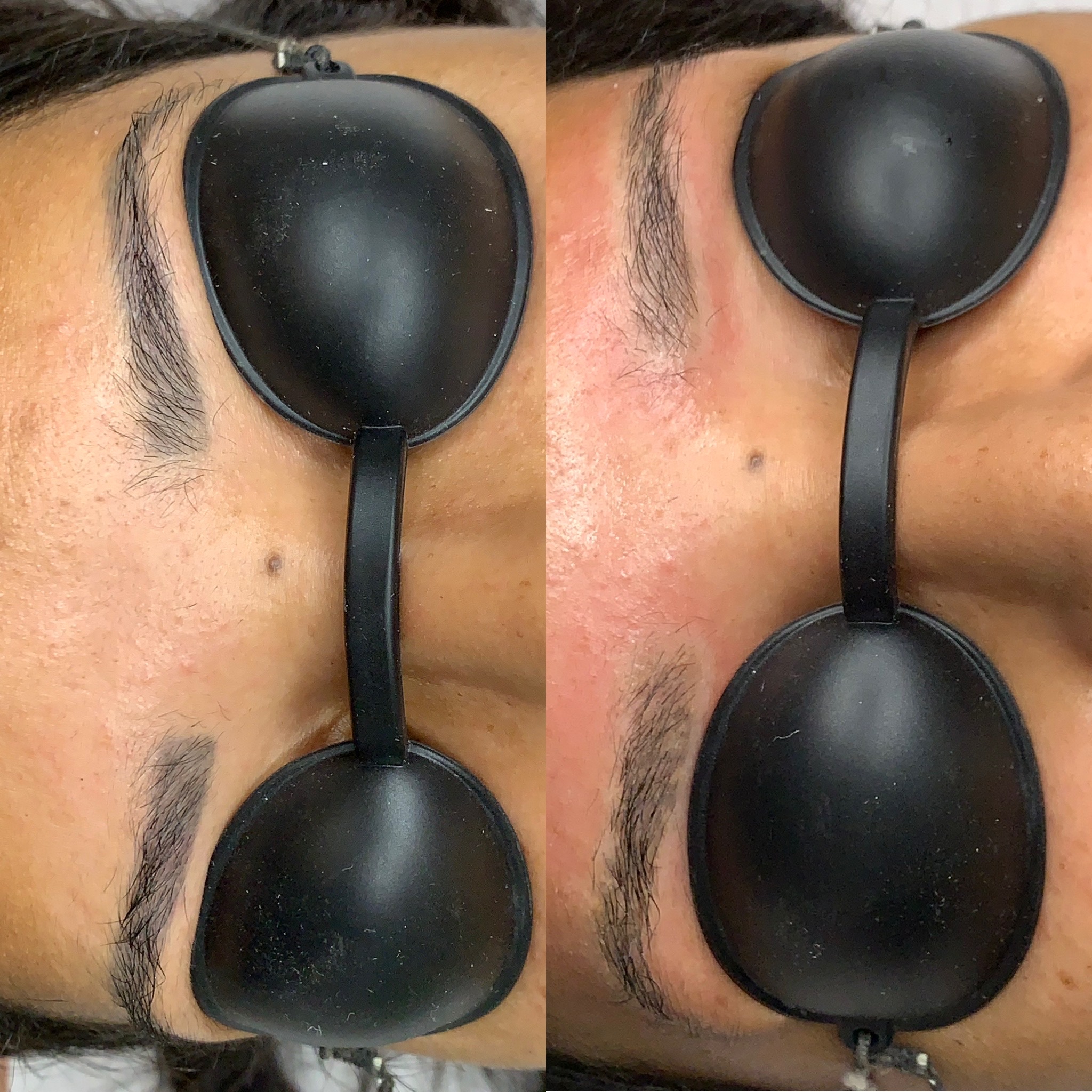 Resultado de remoção a laser